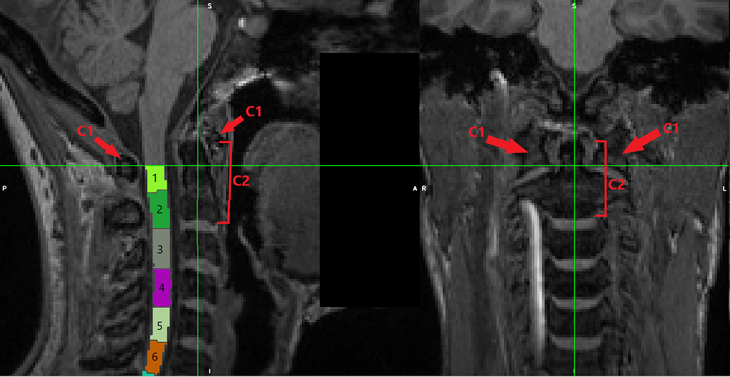 C1 vertebral level labelling - SCT - Spinalcordmri.org